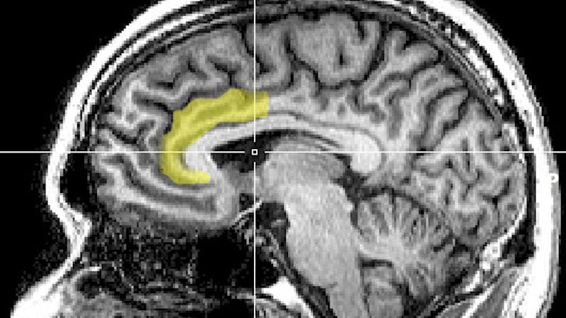 MRI Anterior Cingulate